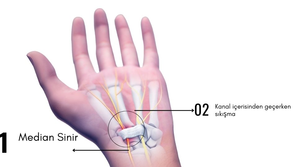 Karpal Tünel Sendromu görseli - DrCem hastalık rehberi